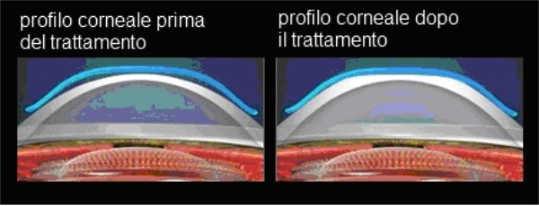 profilo corneale